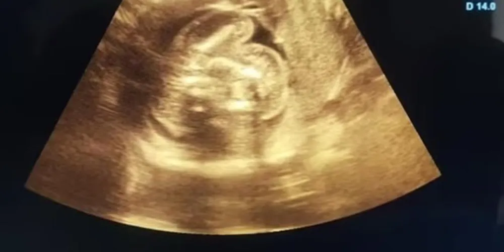 Exame mostra o bebê com dois fetos subdesenvolvidos no abdômen