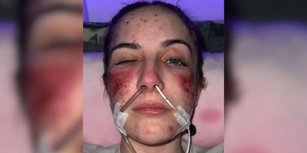 Primeiro surto da doença ocorreu quando Beth tinha 15 anos