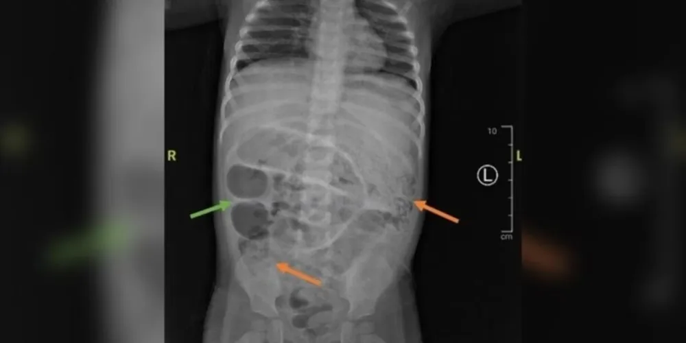 Na imagem, é possível ver os vermes dentro do menino