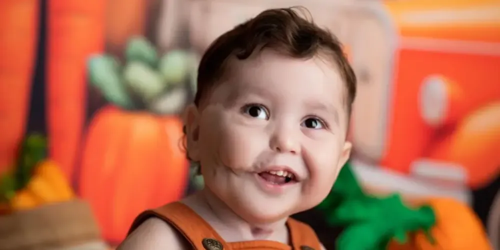 Bebê nasceu com o tumor Epignathus Imaturo 3