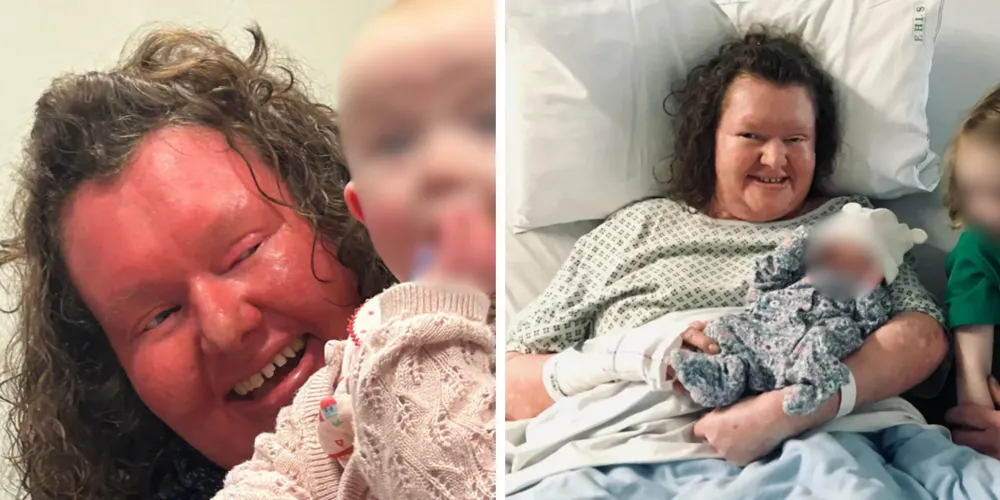 Georgina Burrough nasceu com uma condição genética da pele extremamente rara. Ela teve duas filhas saudáveis, que não herdaram sua condição