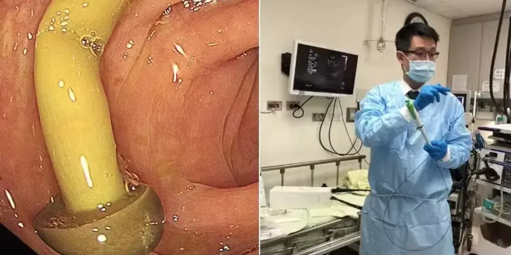 Médico encontra cogumelo crescendo em intestino de paciente