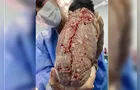 Bebê nasce com DIU colado ao corpo e caso viraliza nas redes
