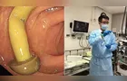 Médico encontra cogumelo crescendo em intestino de paciente; entenda
