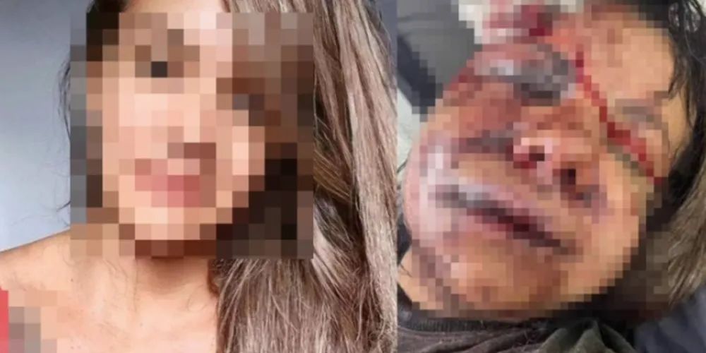 Mulher espancada com 60 socos por ex passará por reconstrução facial