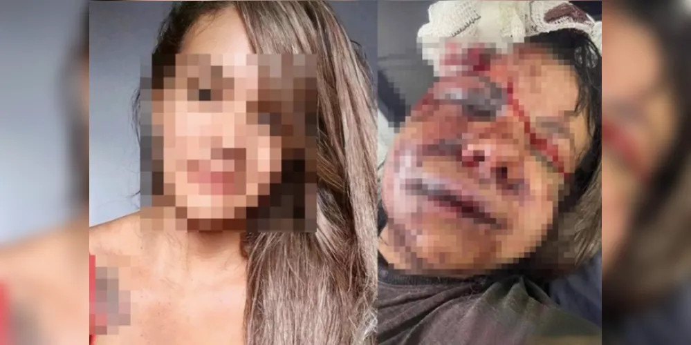 Mulher espancada com 60 socos por ex passará por reconstrução facial