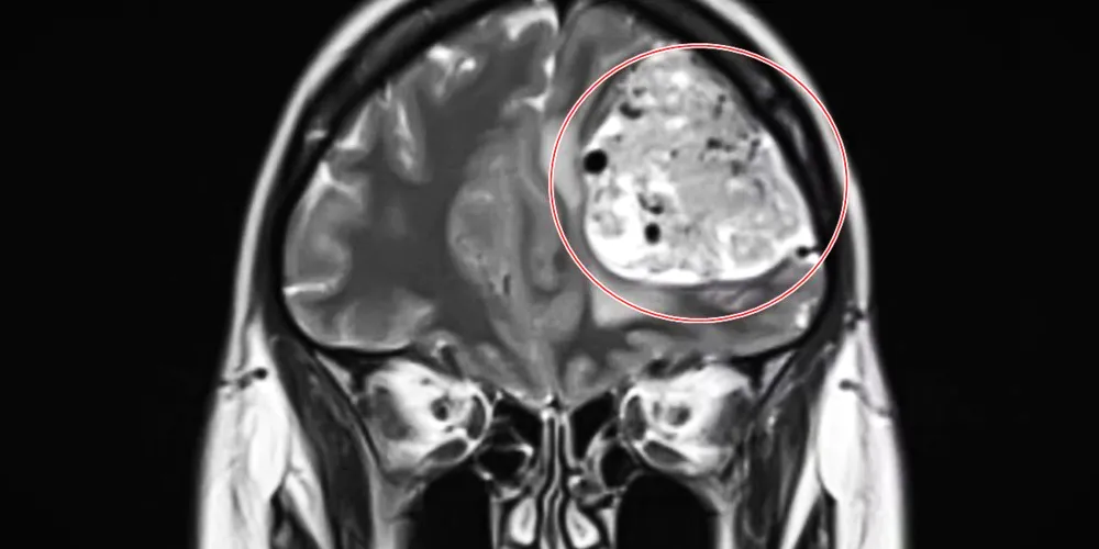 Exame constatou o tumor cerebral benigno