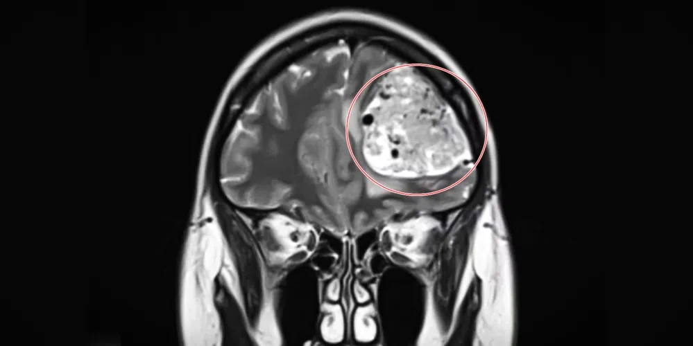 Exame constatou o tumor cerebral benigno