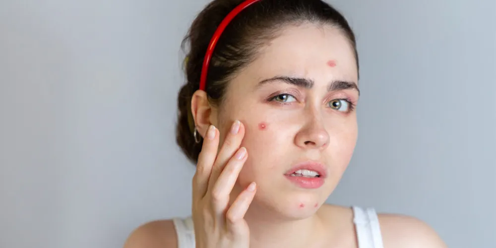 Durante os meses mais frios, como julho, o uso de água quente e o ressecamento do clima podem estimular ainda mais a produção de sebo