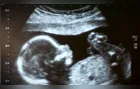 Jovem asfixia e joga recém-nascido em lixão ao forçar aborto