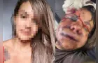 Mulher espancada com 60 socos por ex passará por reconstrução facial
