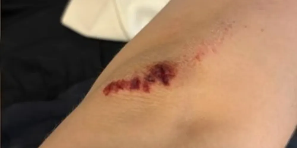 Adolescente teve ferimentos leves