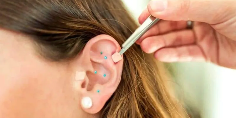 A técnica é realizada com sementes ou cristais aplicados em regiões específicas da orelha