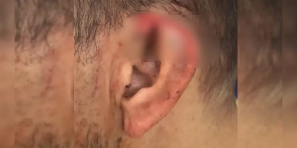 Homem de 29 anos foi detido após morder e arrancar parte da orelha de seu companheiro, de 19 anos