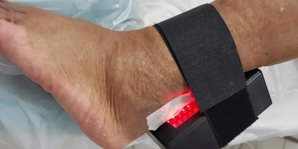 Dispositivo desenvolvido para evitar a amputação