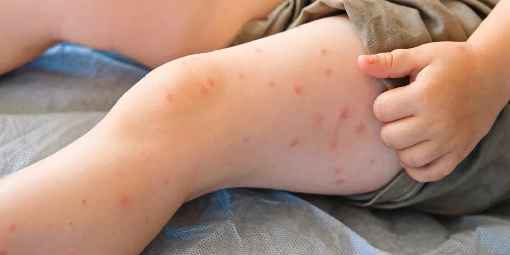 Criança com sarampo