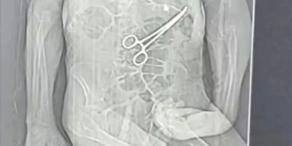 Secretaria admite ter identificado corpo estranho no abdôme de Manoel Cardoso e fez nova cirurgia