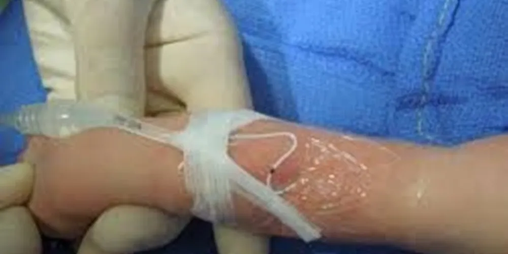 Paraná registra 2.060 incidentes associados aos cuidados em saúde em recém-nascidos entre 2014 e 2022