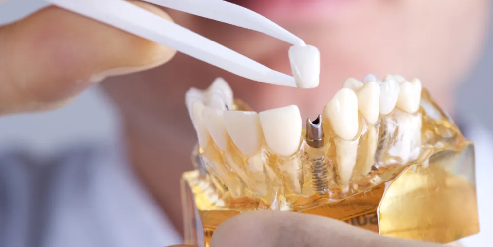 Agende sua avaliação na FisiodontoMed. Se você perdeu um ou mais dentes, não adie seu sorriso