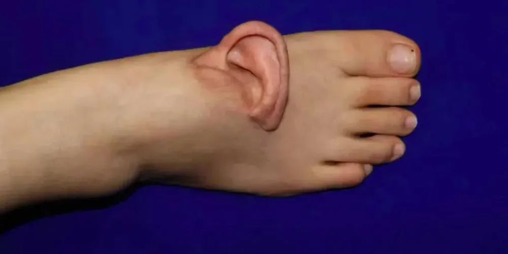 Os cirurgiões conseguiram conectar a complexa rede de veias delicadas da orelha no peito do pé