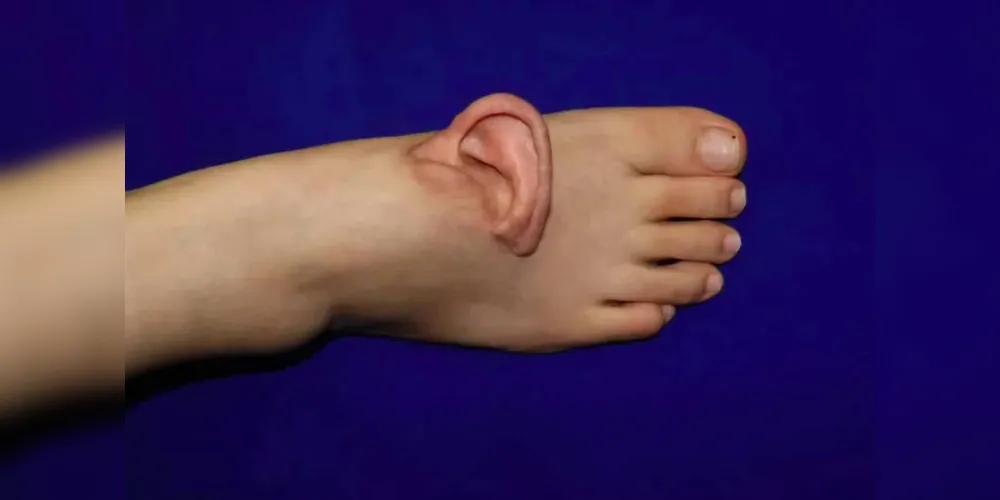 Os cirurgiões conseguiram conectar a complexa rede de veias delicadas da orelha no peito do pé