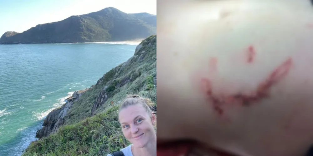 Nesta semana, Fabiana deve retirar os pontos e iniciar uma nova etapa do processo de recuperação