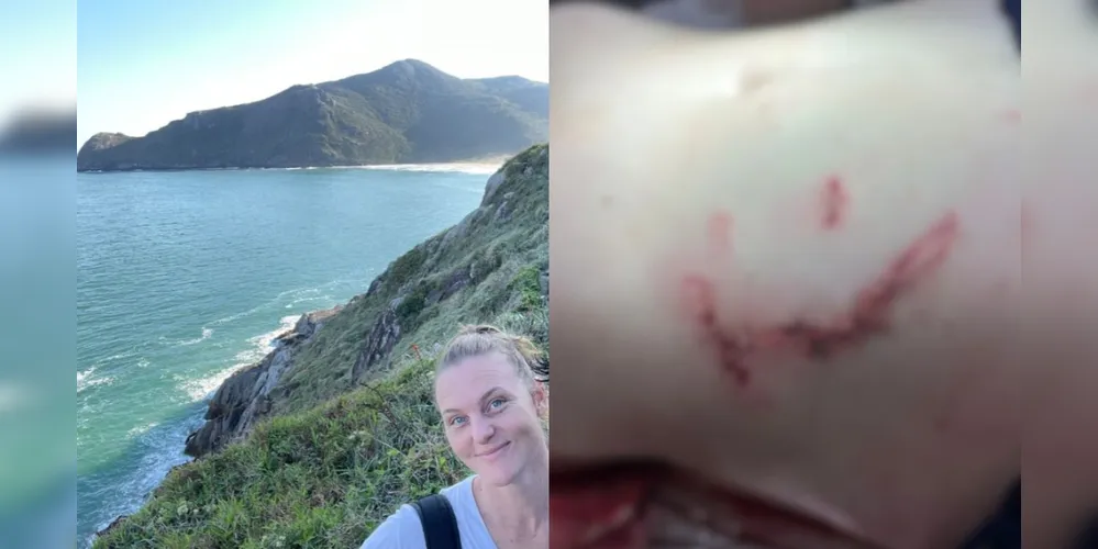 Nesta semana, Fabiana deve retirar os pontos e iniciar uma nova etapa do processo de recuperação