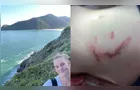 Psicóloga é atacada por capivara durante acampamento no litoral catarinense