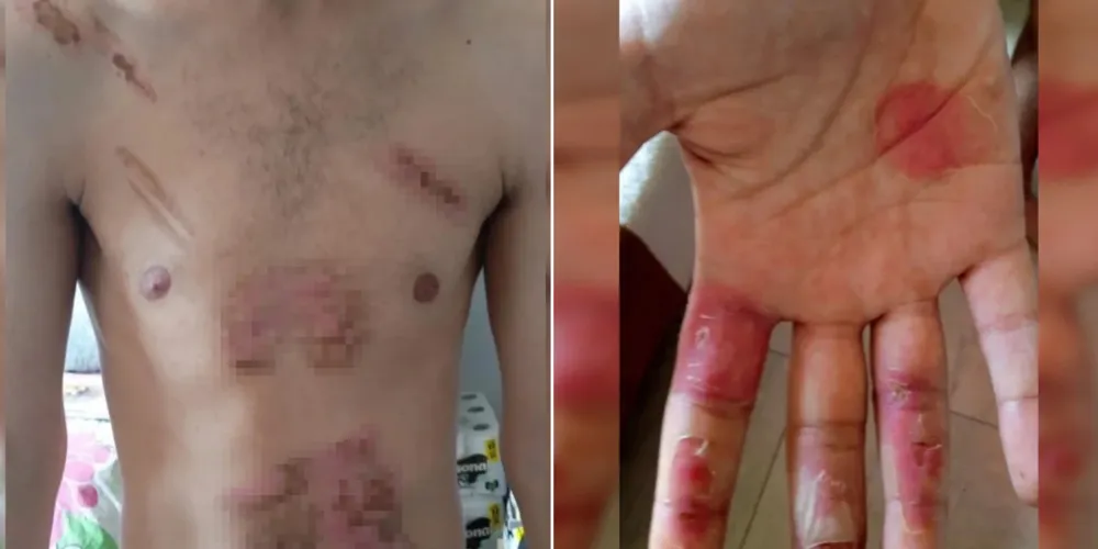 Homem teve queimaduras sérias em grande parte do corpo