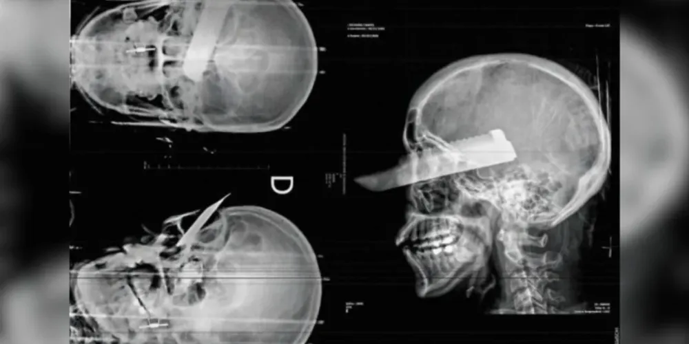 Raio X mostra que a faca foi “cravada” na cabeça da mulher