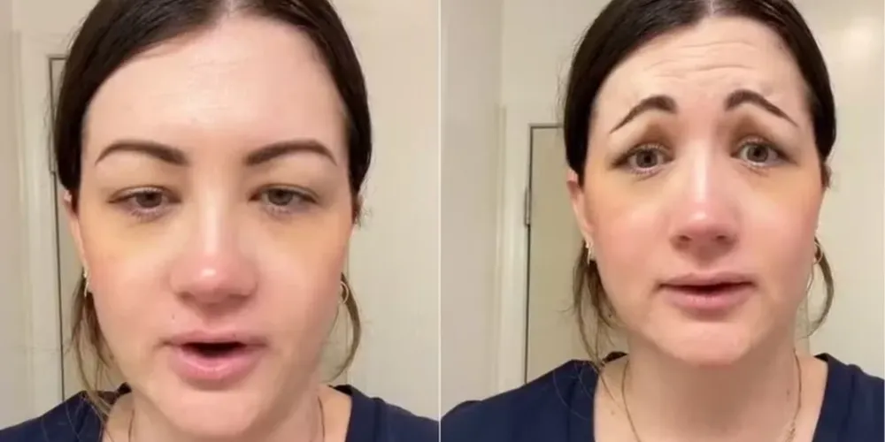 Ao que tudo indica, o profissional deixou de aplicar a toxina em uma área específica da testa