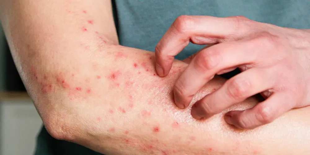 A mpox é causada por um vírus transmitido principalmente por contato íntimo