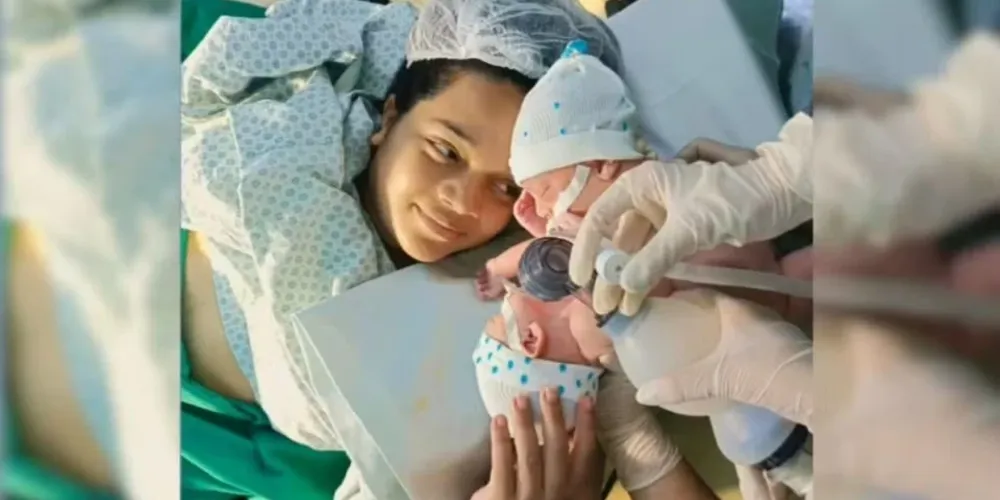 Os bebês Marcos e Matheus nasceram unidos pela região pélvica