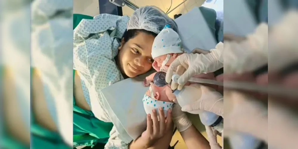 Os bebês Marcos e Matheus nasceram unidos pela região pélvica