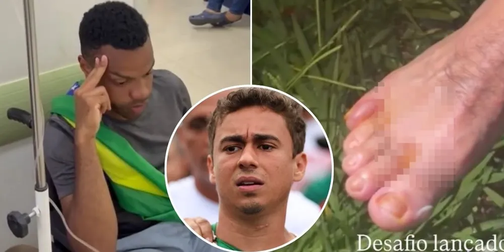 Registro mostra bolhas entre os dedos de manifestantes que acompanham a “Caminhada da Liberdade” de 240 km de Nikolas Ferreira