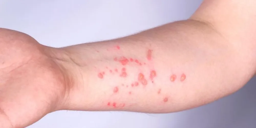 Um dos principais sintomas da mpox é a erupção na pele (bolhas, feridas ou crostas)