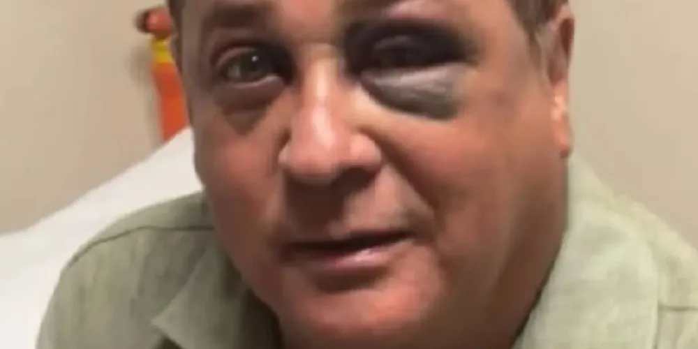 O cantor Leonardo aparece machucado após queda durante pescaria à noite