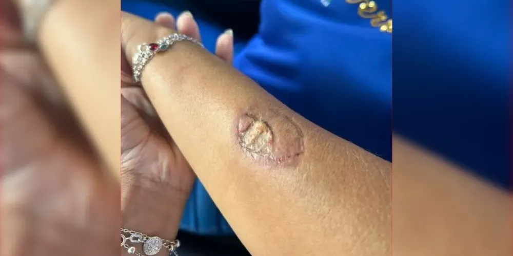 Suspeita teria mordido o braço da vice-diretora