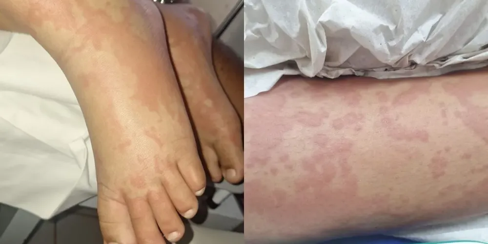 Criança está internada com diversas manchas pelo corpo