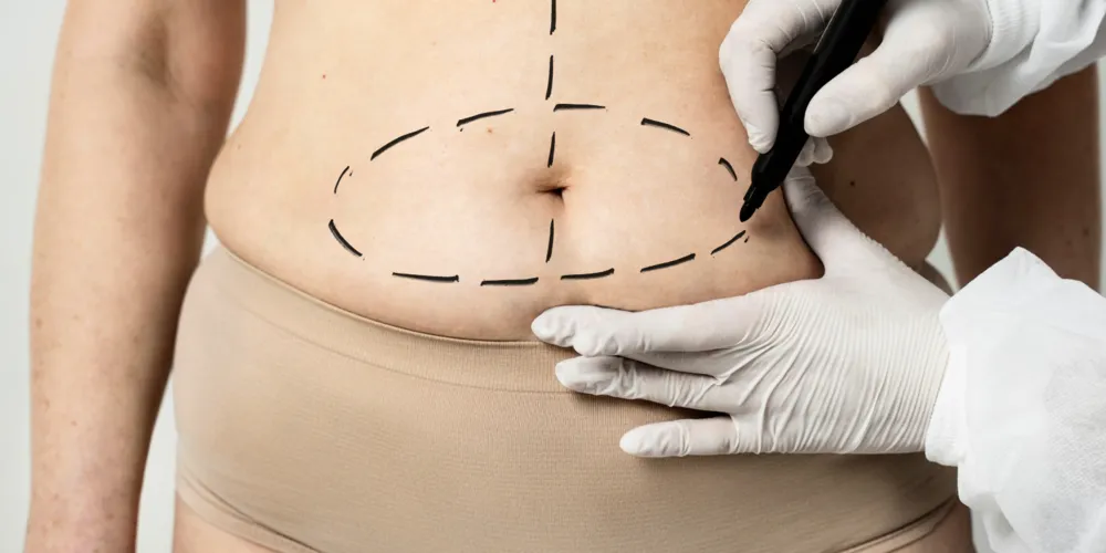 Com a cirurgia, é possível melhorar o contorno corporal, tratar a diástase e retirar o excesso de pele