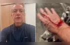 Apresentador da Globo é atacado por pitbull e mostra ferimentos
