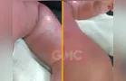 Bebê queimado em creche de Sarandi vai para cirurgia em estado grave