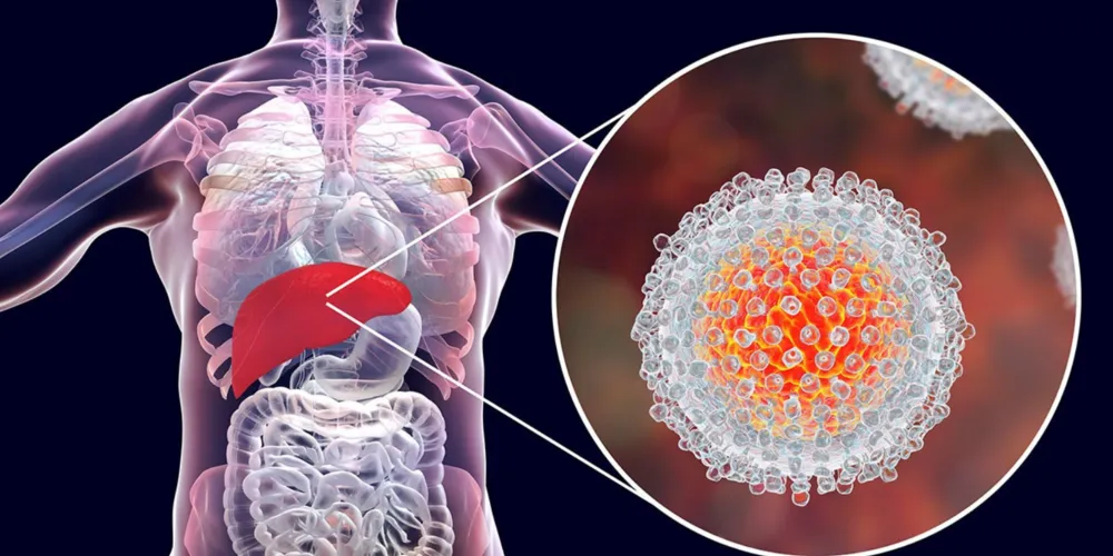 Entre 2000 e 2024, o Brasil registrou mais de 826 mil casos confirmados de hepatites virais