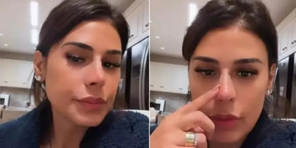 Simone Mendes foi alvo de críticas nas redes sociais pelo resultado de procedimentos no nariz