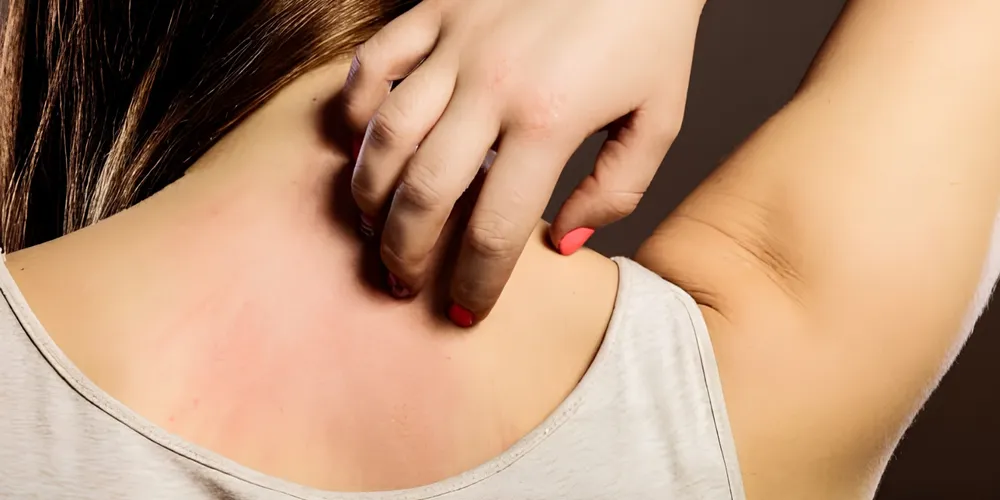 O tratamento da dermatite atópica é individualizado e leva em consideração fatores como idade, intensidade dos sintomas e extensão das áreas afetadas