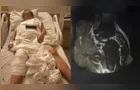 Idosa passa por cirurgia no joelho errado em hospital de Curitiba
