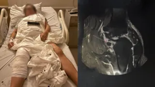 Idosa acorda de cirurgia e descobre que prótese foi colocada no joelho errado, em Curitiba