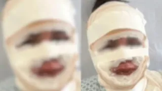 Mulher joga água fervente na atual namorada do ex e acaba presa