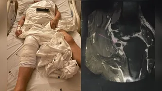 Hospital se pronuncia sobre cirurgia no joelho errado de idosa em Curitiba