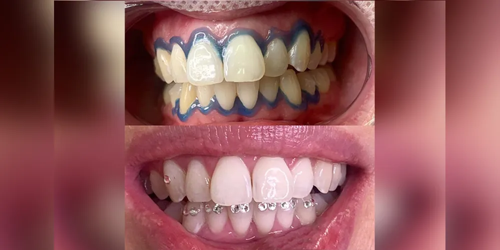 Novidade é que o paciente pode realizar o seu clareamento dentário de consultório não em três seções, mas em apenas uma